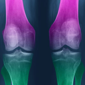 Chondroitin Sulphate Better Than Celebrex For Knee Joint Health